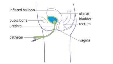 Female indwelling urinary catheter