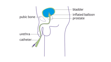 Male indwelling urinary catheter